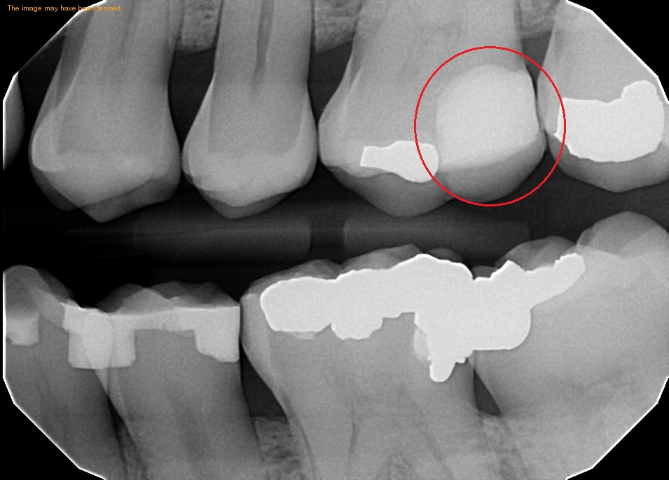 root canal glenmont ny