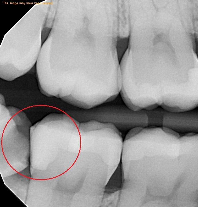 tooth extraction glenmont ny