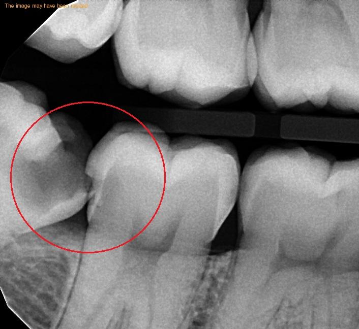 wisdom tooth extraction glenmont ny