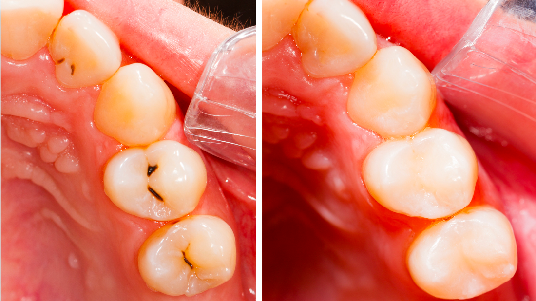 Bethlehem Town Family Dental Blog Molar Filling