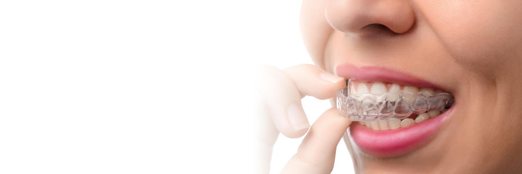 woman putting on Invisalign clear aligners in glenmont ny 