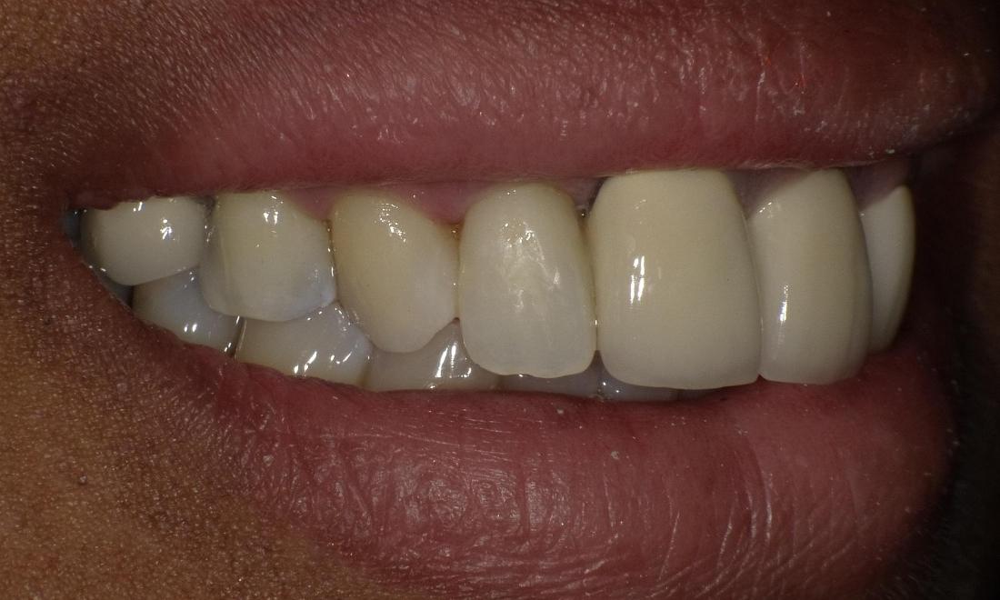 Composite fillings | Bethlehem Town Family Dental | Glenmont, NY