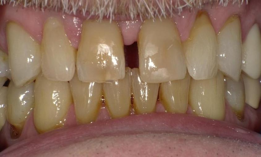 Repaired broken tooth | Bethlehem Town Family Dental | Glenmont, NY