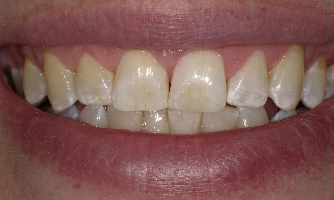 Repaired chipped tooth | Bethlehem Town Family Dental | Glenmont, NY