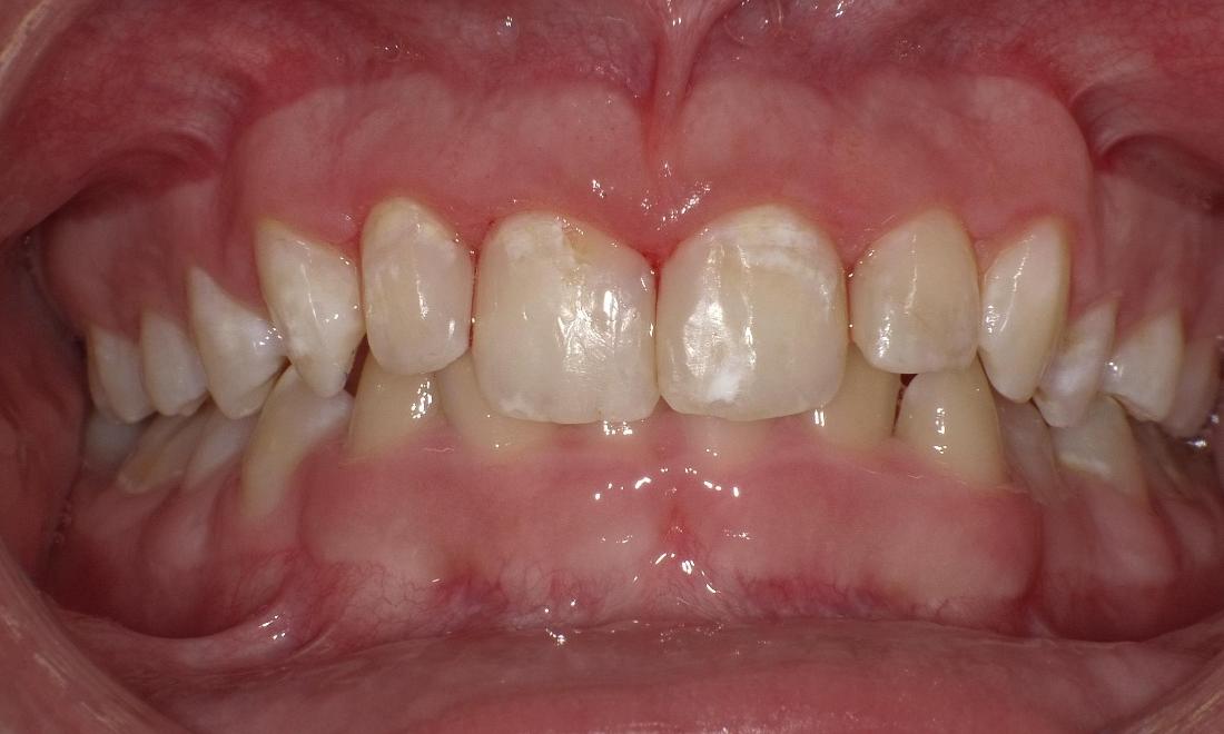 After composite restoration | Bethlehem Town Family Dental | Glenmont, NY