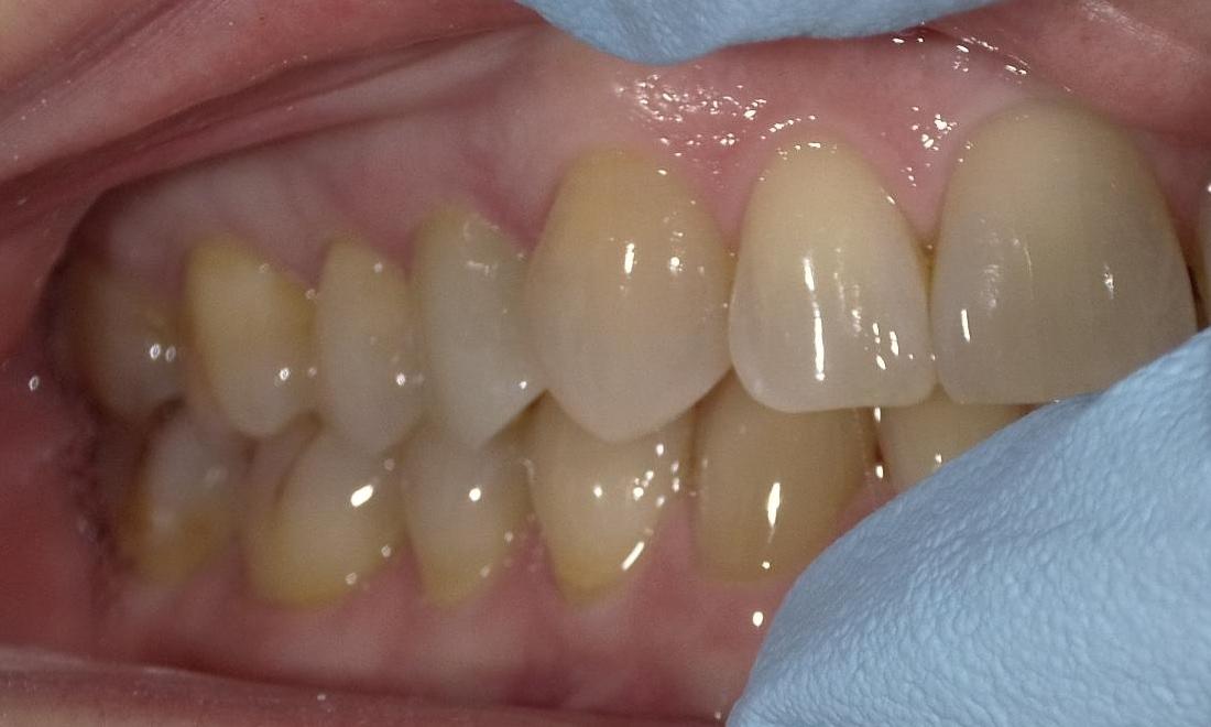 Composite Crown | Bethlehem Town Family Dental | Glenmont, NY