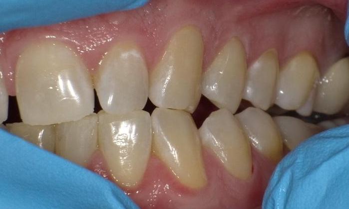 Image of the same teeth without cavities after treatment | Bethlehem Town Family Dental | Glenmont, NY