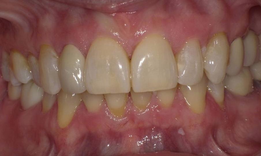 Single veneer | Bethlehem Town Family Dental | Glenmont, NY