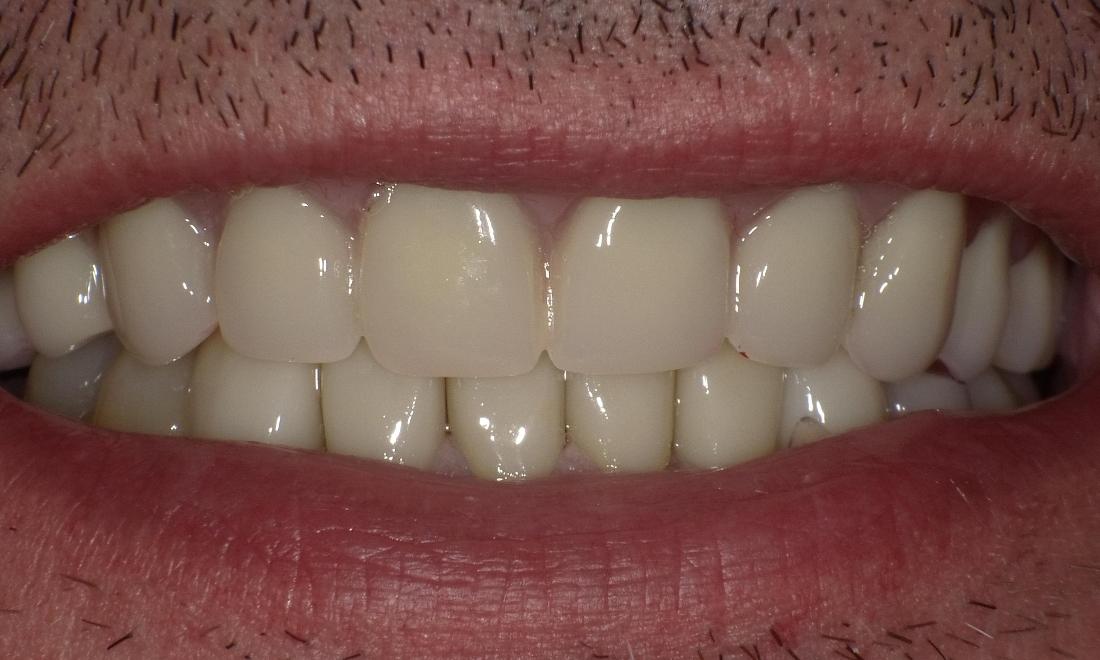 After Dentures | Bethlehem Town Family Dental | Glenmont, NY