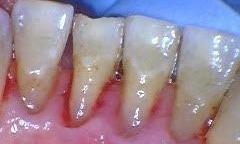 Deep Cleaning | Bethlehem Town Family Dental | Glenmont, NY