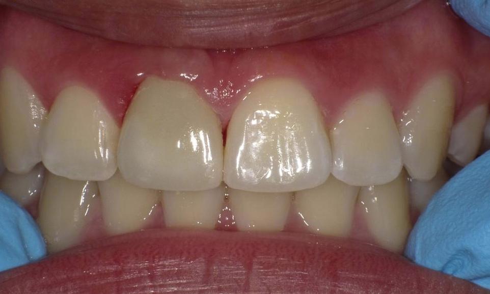 Replaced crown | Bethlehem Town Family Dental | Glenmont, NY