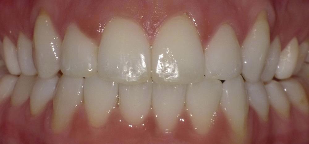 Image of same teeth after straightening with Invisalign | Bethlehem Town Family Dental | Glenmont, NY