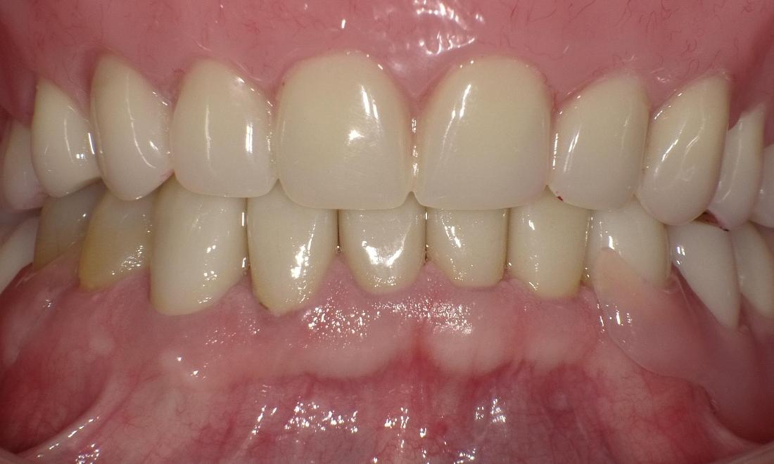 After Dentures | Bethlehem Town Family Dental | Glenmont, NY