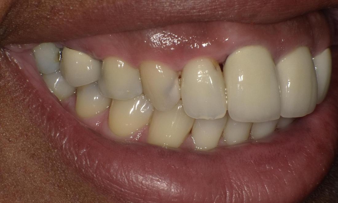 Cavity before | Bethlehem Town Family Dental | Glenmont, NY