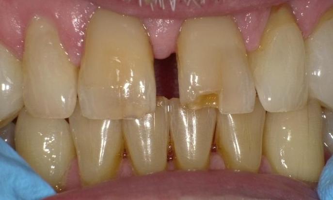 Broken front tooth before | Bethlehem Town Family Dental | Glenmont, NY