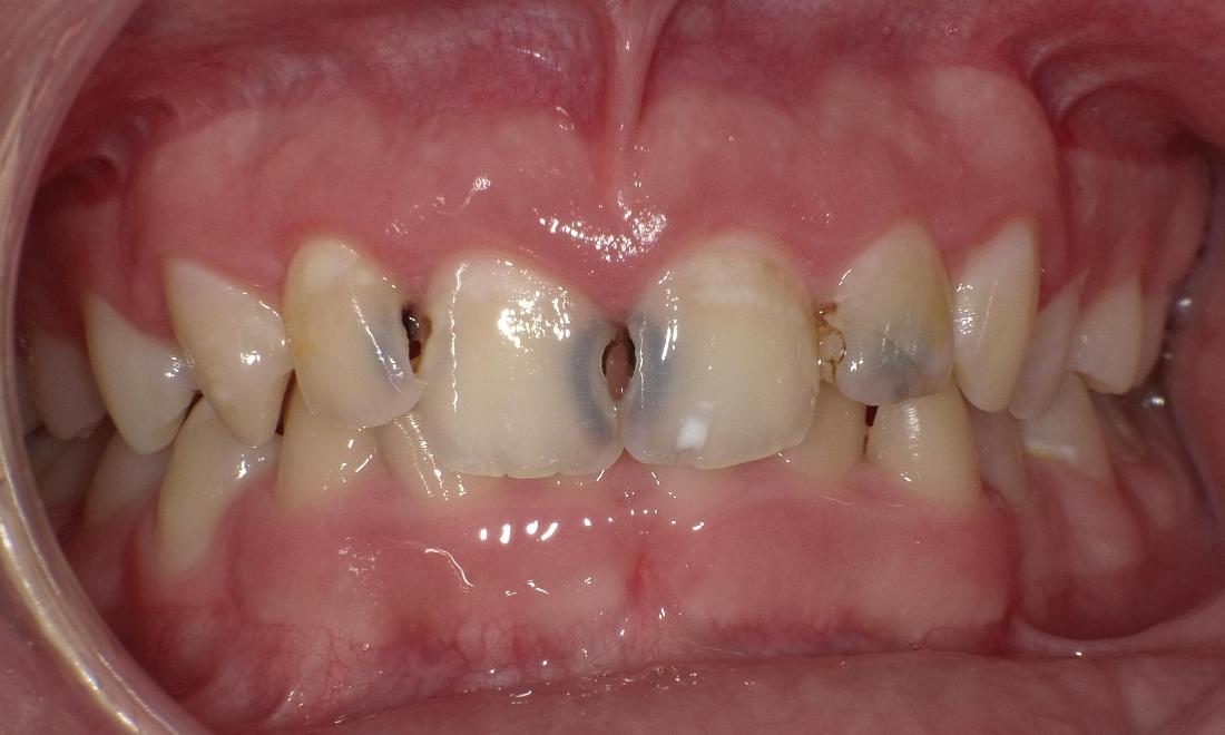 Before composite fillings | Bethlehem Town Family Dental | Glenmont, NY