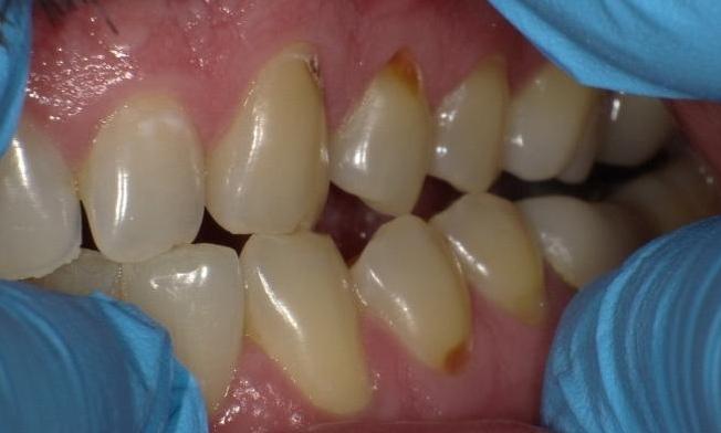 Image of teeth with cavities | Bethlehem Town Family Dental | Glenmont, NY