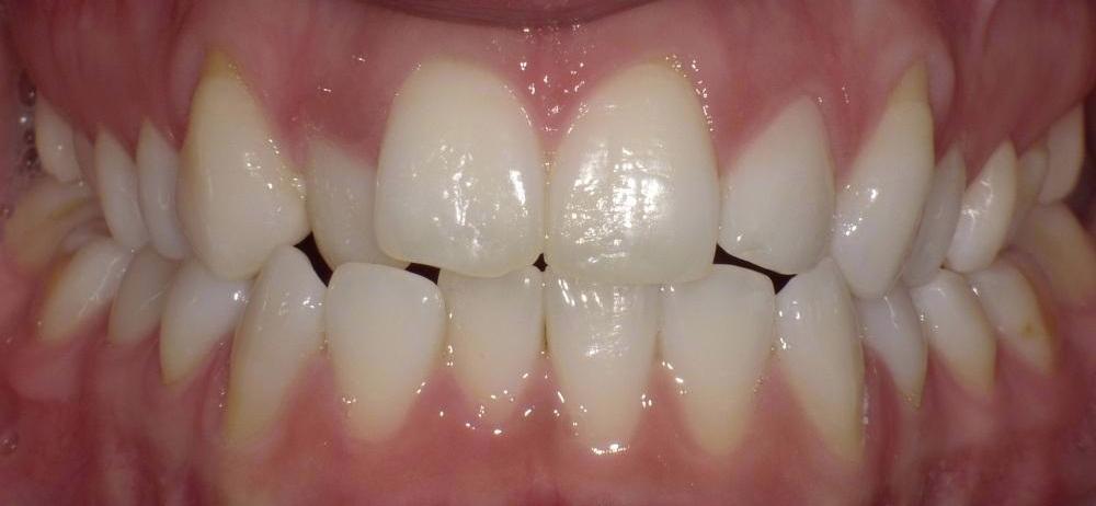 Image of teeth in poor positions | Bethlehem Town Family Dental | Glenmont, NY