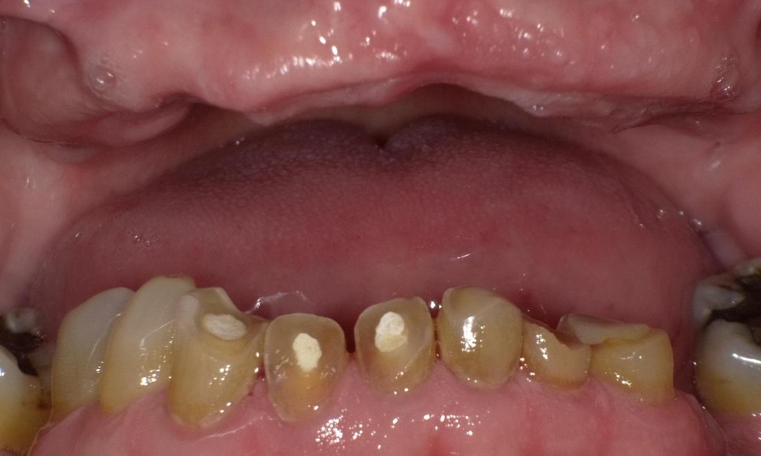 Before Dentures | Bethlehem Town Family Dental | Glenmont, NY