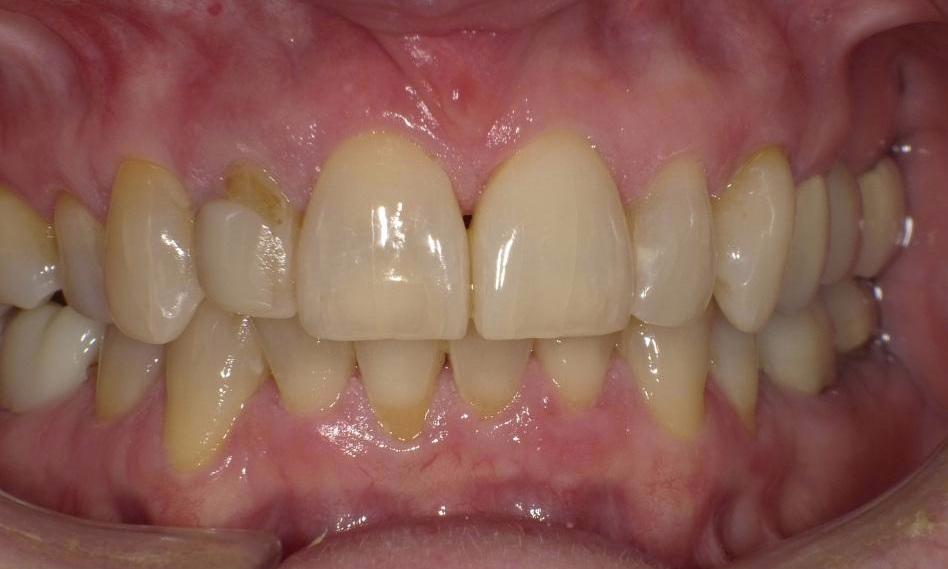 Broken bonding | Bethlehem Town Family Dental | Glenmont, NY