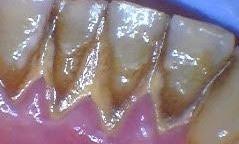 Build up of calculus and stains | Bethlehem Town Family Dental | Glenmont, NY