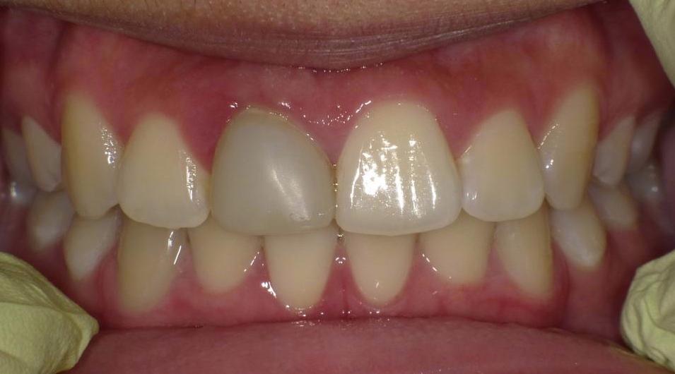 Mis-matched crown | Bethlehem Town Family Dental | Glenmont, NY