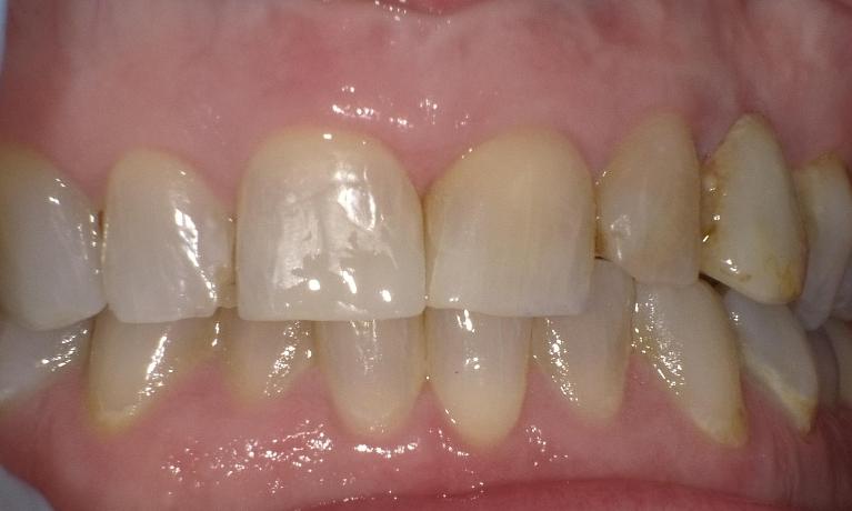 Repaired front chipped tooth | Bethlehem Town Family Dental | Glenmont, NY