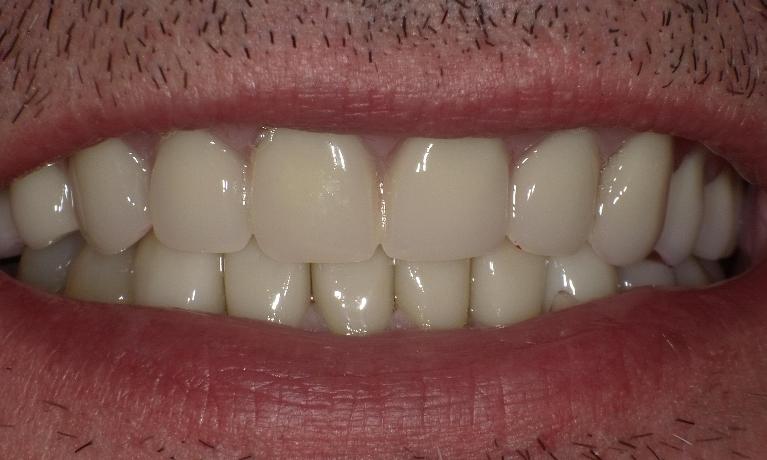 Total-Smile-Makeover-Crowns-Fillings-and-Dentures-After-Image