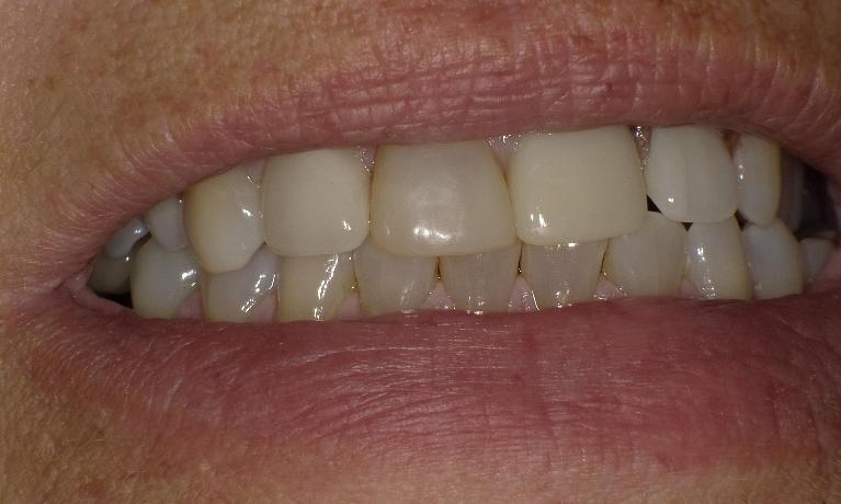 Crowns-Partial-Dentures-and-Fillings-After-Image