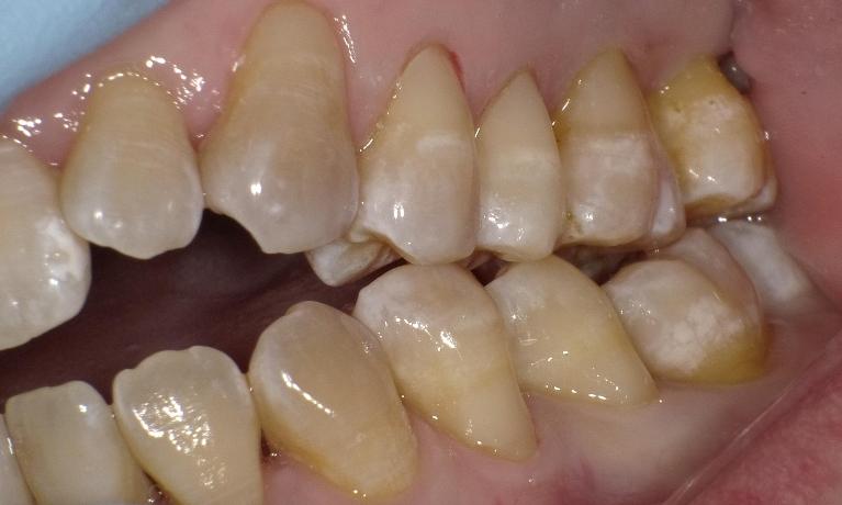 Repaired Toothbrush Abrasion | Bethlehem Town Family Dental | Glenmont, NY