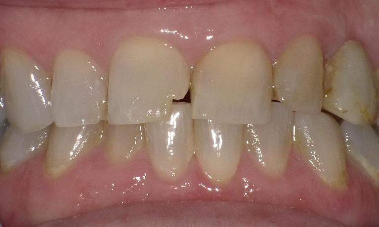 Chipped Tooth | Bethlehem Town Family Dental | Glenmont, NY