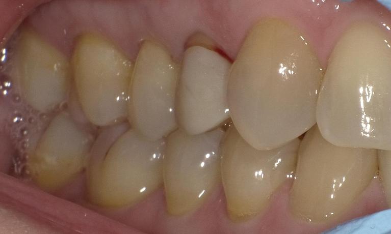 Off-colored crowns | Bethlehem Town Family Dental | Glenmont, NY